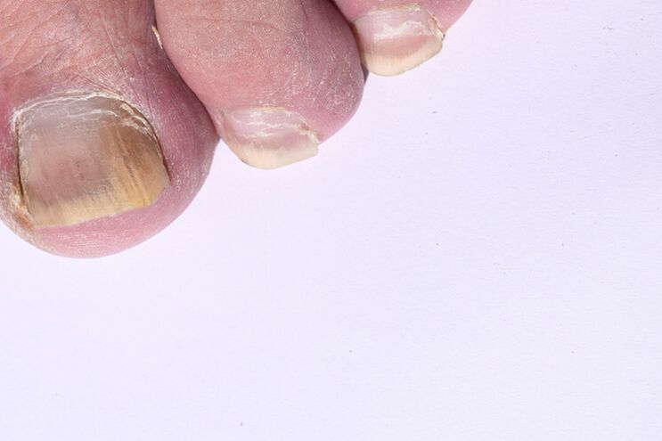 nail gombás lábra utolsó szakasz kezelése