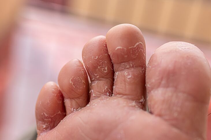 az ujjak bőrének gomba - a kezdeti szakasz