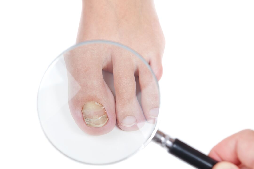 nail gomba fertőző betegség
