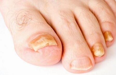 kezelése patogén gomba a körmök medicine a gomba körmök a lábak belső