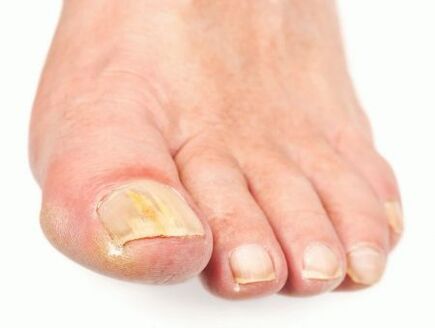 a körmök károsodása gombával a lábakon