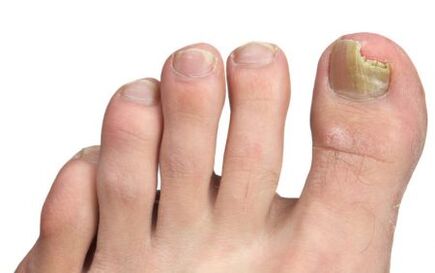 gomba toenails kezdeti szakaszban