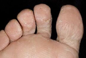 gombás tünetek a láb bőrén