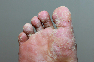 Súlyos szakaszában a gombás fertőzések, a bőr lábujjak
